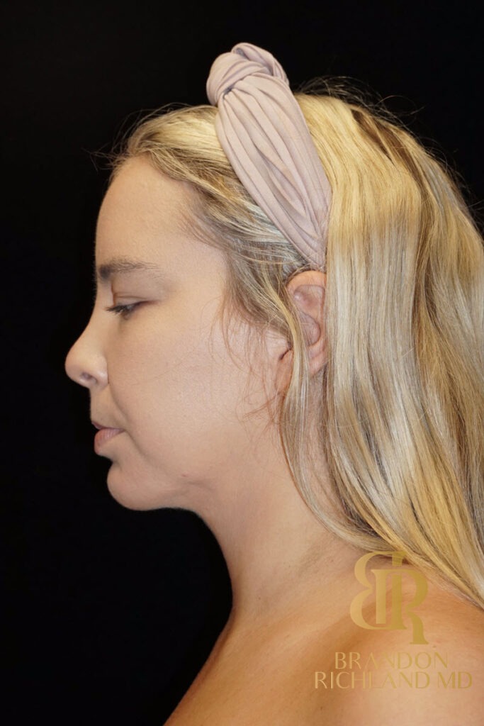 Chin Liposuction After, Patient 03, view 6 — Dr. Brandon Richland, Newport Beach