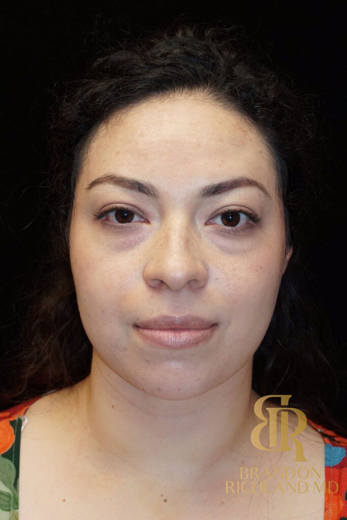 Chin Liposuction After, Patient 04, view 1 — Dr. Brandon Richland, Newport Beach
