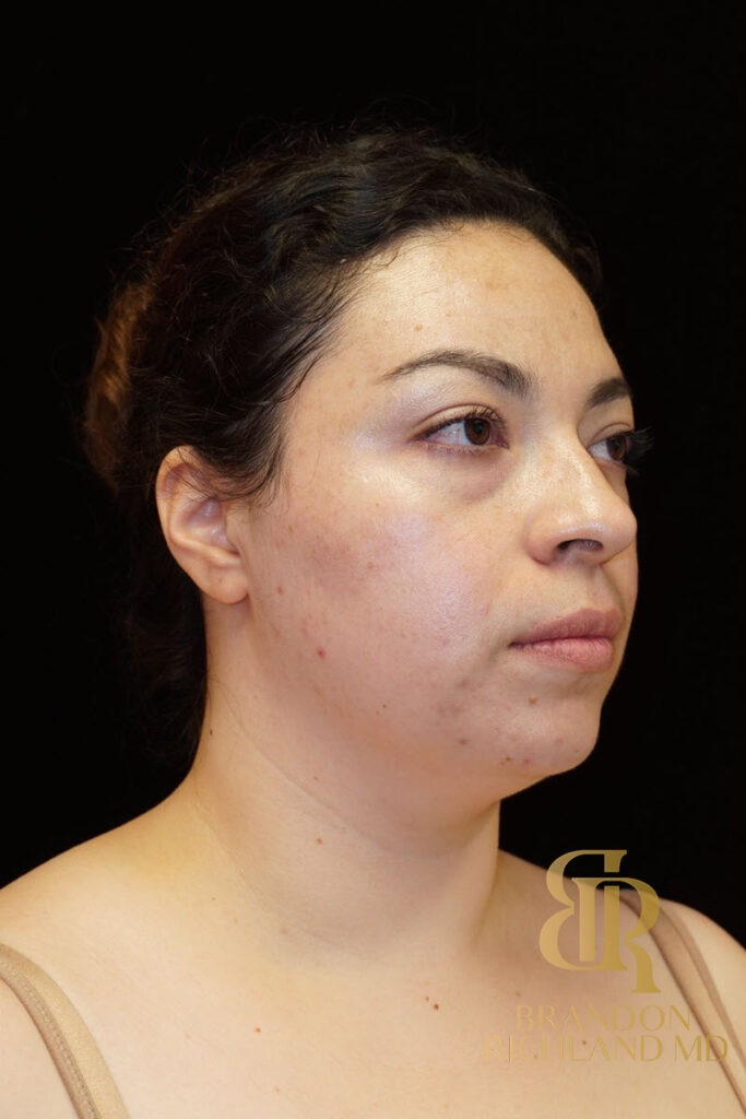 Chin Liposuction Before, Patient 04, view 2 — Dr. Brandon Richland, Newport Beach