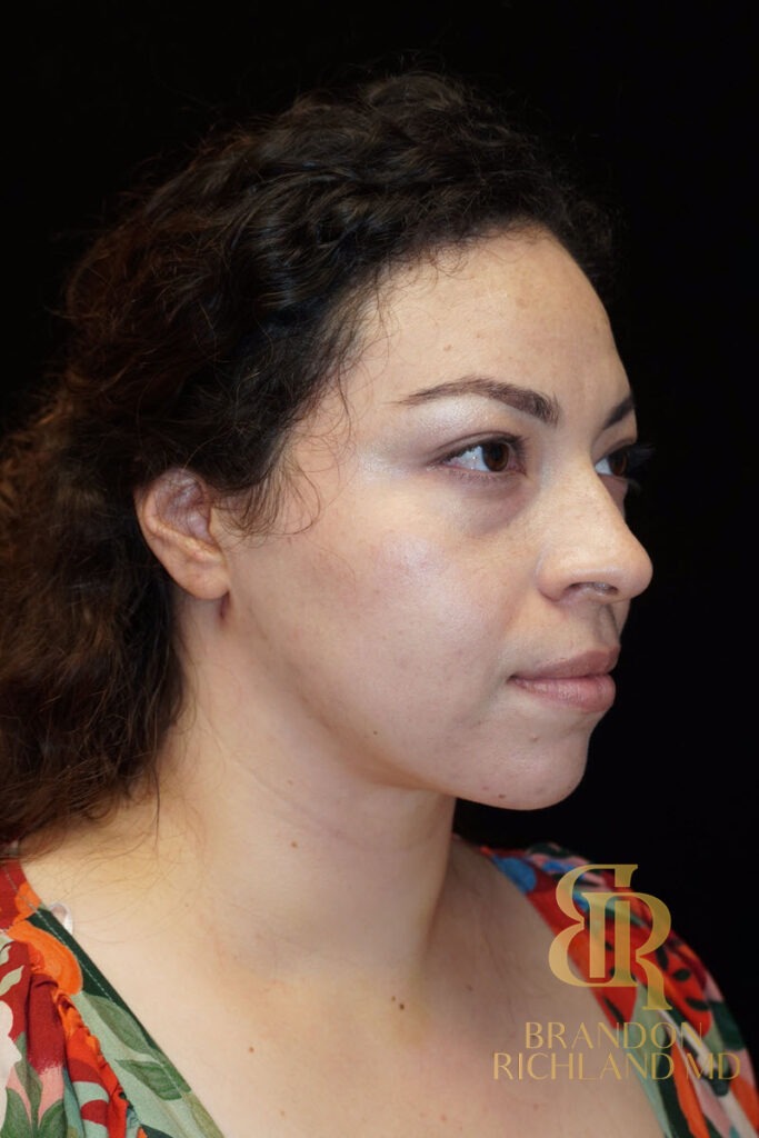 Chin Liposuction After, Patient 04, view 2 — Dr. Brandon Richland, Newport Beach