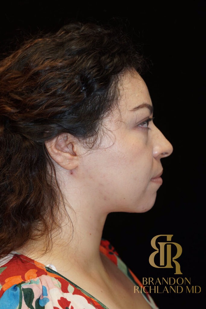 Chin Liposuction After, Patient 04, view 3 — Dr. Brandon Richland, Newport Beach