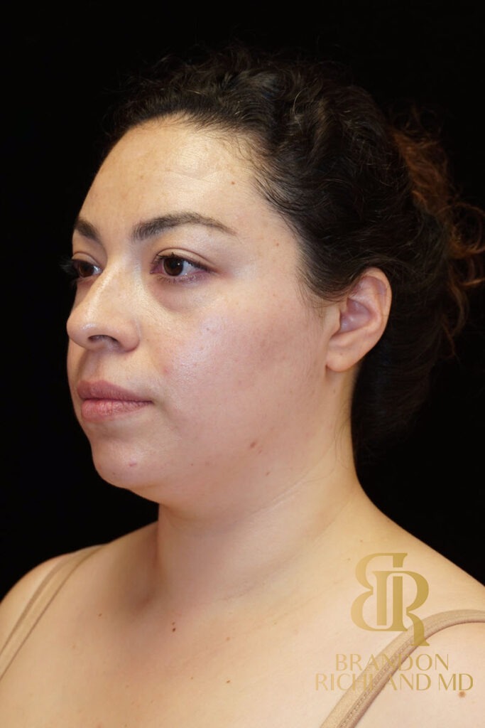 Chin Liposuction Before, Patient 04, view 5 — Dr. Brandon Richland, Newport Beach
