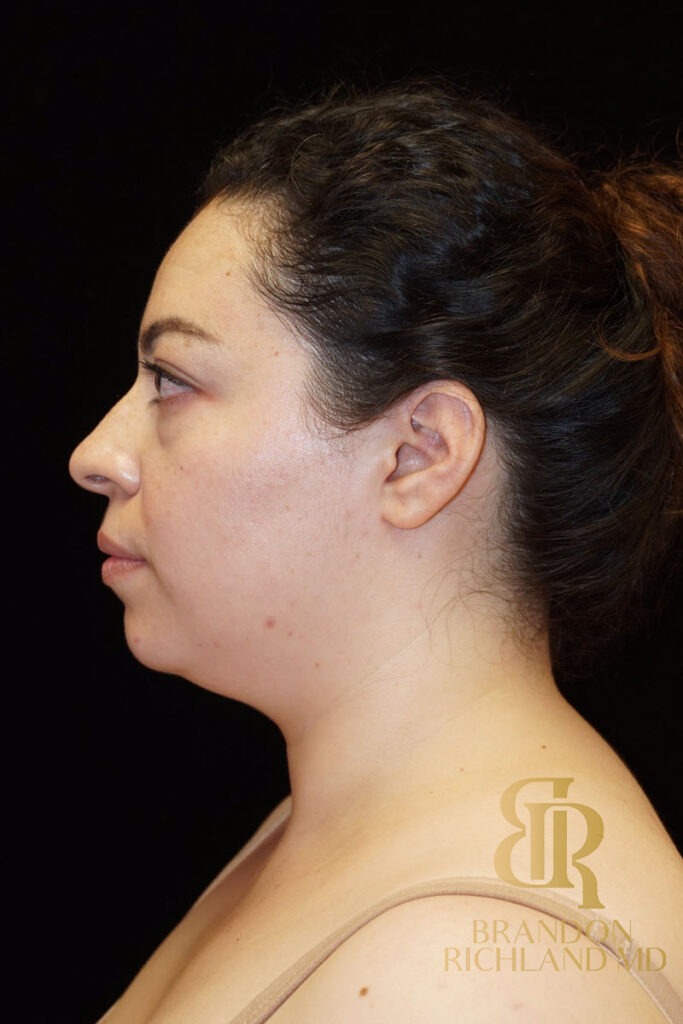 Chin Liposuction Before, Patient 04, view 6 — Dr. Brandon Richland, Newport Beach