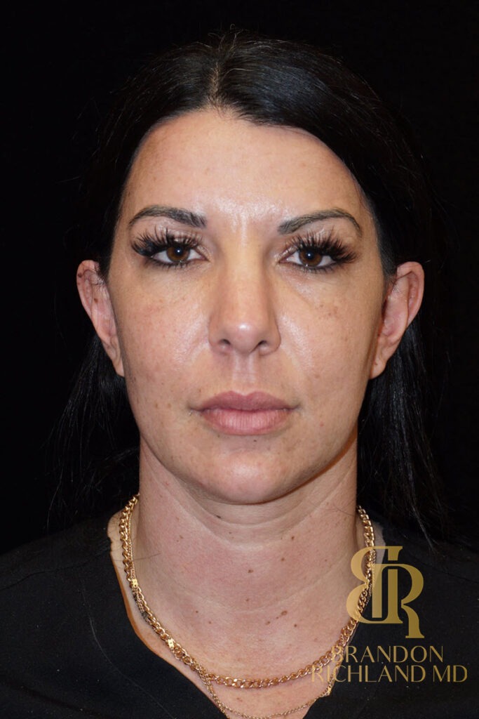 Chin Liposuction Before, Patient 05, view 1 — Dr. Brandon Richland, Newport Beach