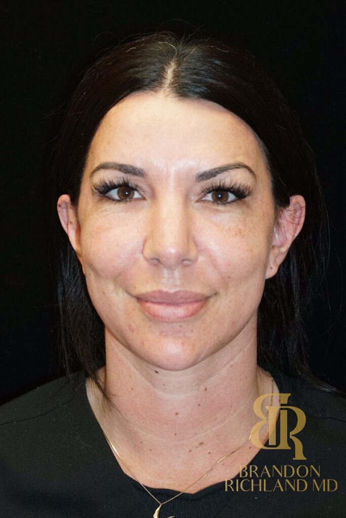 Chin Liposuction After, Patient 05, view 1 — Dr. Brandon Richland, Newport Beach