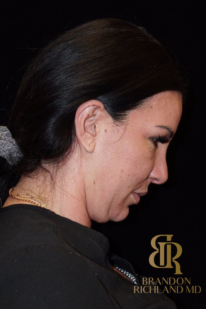 Chin Liposuction Before, Patient 05, view 4 — Dr. Brandon Richland, Newport Beach