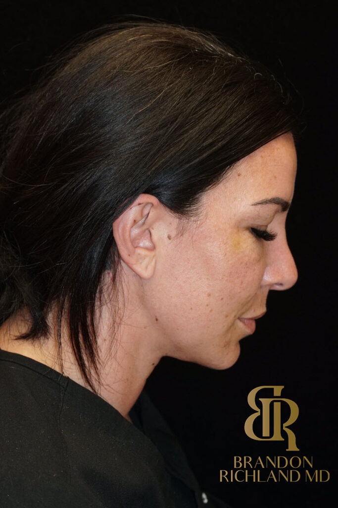 Chin Liposuction After, Patient 05, view 4 — Dr. Brandon Richland, Newport Beach