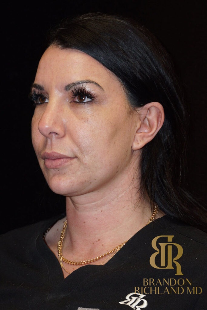 Chin Liposuction Before, Patient 05, view 5 — Dr. Brandon Richland, Newport Beach