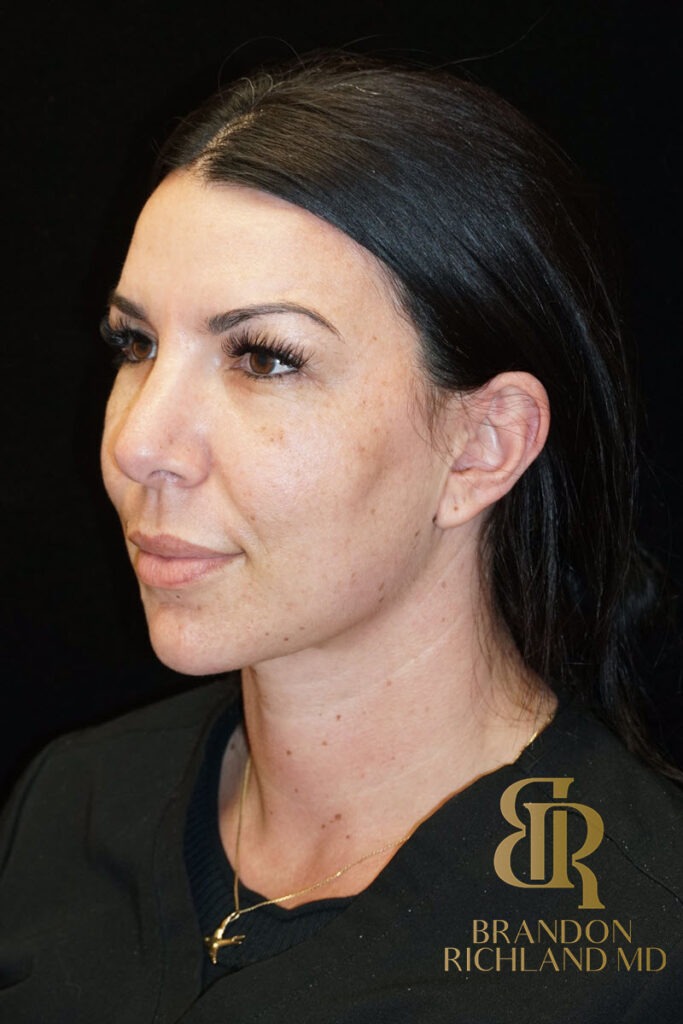 Chin Liposuction After, Patient 05, view 5 — Dr. Brandon Richland, Newport Beach