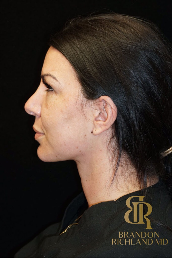 Chin Liposuction After, Patient 05, view 6 — Dr. Brandon Richland, Newport Beach