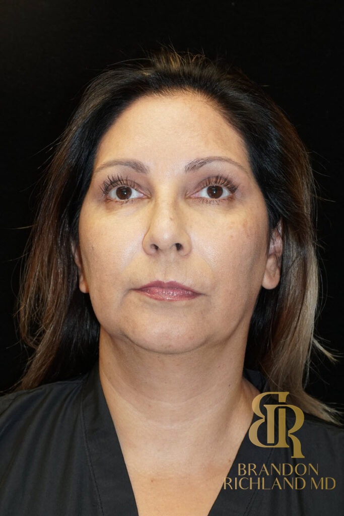 Chin Liposuction Before, Patient 06, view 1 — Dr. Brandon Richland, Newport Beach