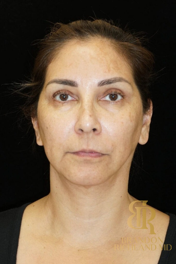 Chin Liposuction After, Patient 06, view 1 — Dr. Brandon Richland, Newport Beach