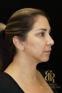 Chin Liposuction before and after, Patient 06 — Dr. Brandon Richland, Newport Beach