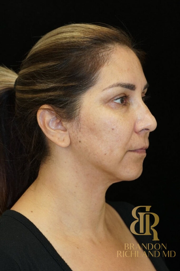 Chin Liposuction After, Patient 06, view 2 — Dr. Brandon Richland, Newport Beach