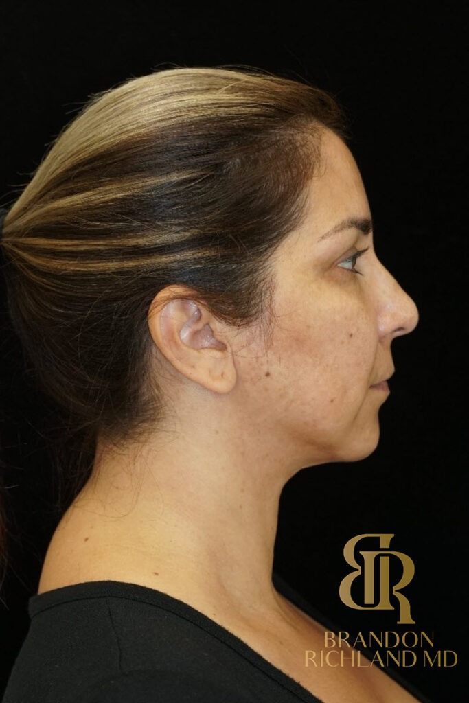 Chin Liposuction After, Patient 06, view 3 — Dr. Brandon Richland, Newport Beach