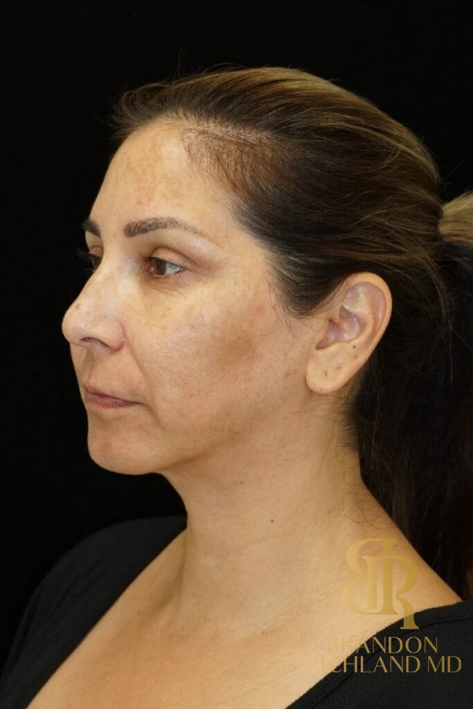 Chin Liposuction After, Patient 06, view 4 — Dr. Brandon Richland, Newport Beach