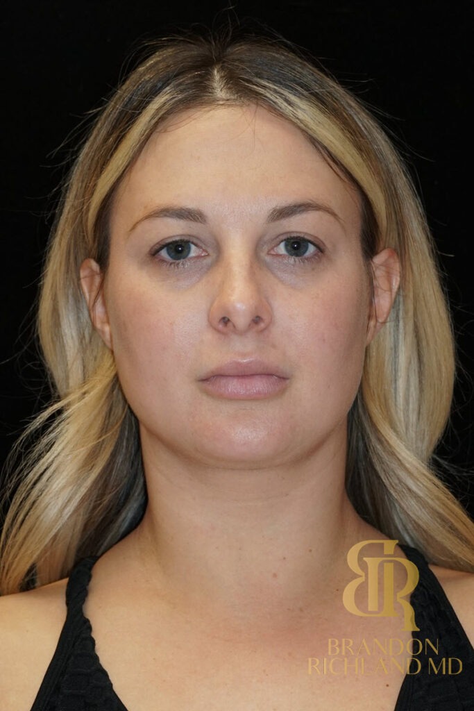 Chin Liposuction Before, Patient 07, view 1 — Dr. Brandon Richland, Newport Beach