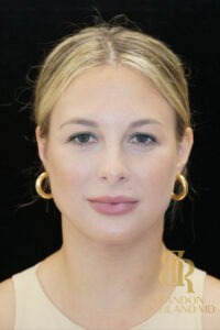 Chin Liposuction before and after, Patient 07 — Dr. Brandon Richland, Newport Beach