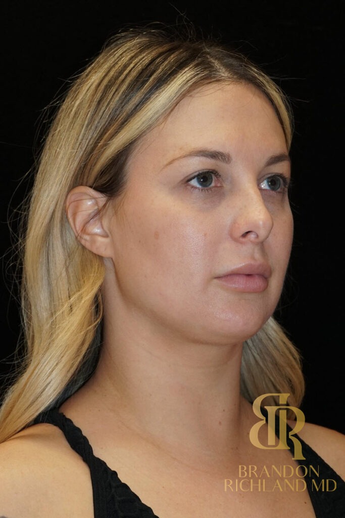 Chin Liposuction Before, Patient 07, view 2 — Dr. Brandon Richland, Newport Beach