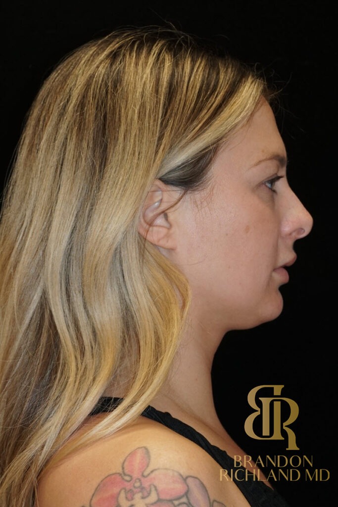 Chin Liposuction Before, Patient 07, view 3 — Dr. Brandon Richland, Newport Beach