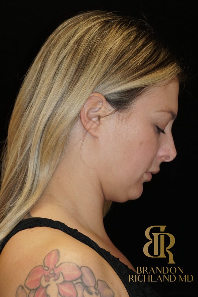 Chin Liposuction Before, Patient 07, view 4 — Dr. Brandon Richland, Newport Beach