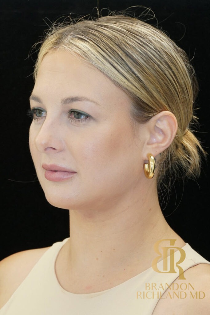 Chin Liposuction After, Patient 07, view 5 — Dr. Brandon Richland, Newport Beach