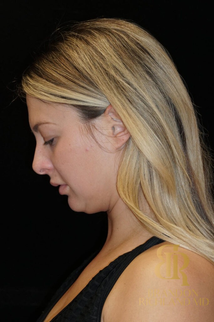 Chin Liposuction Before, Patient 07, view 7 — Dr. Brandon Richland, Newport Beach