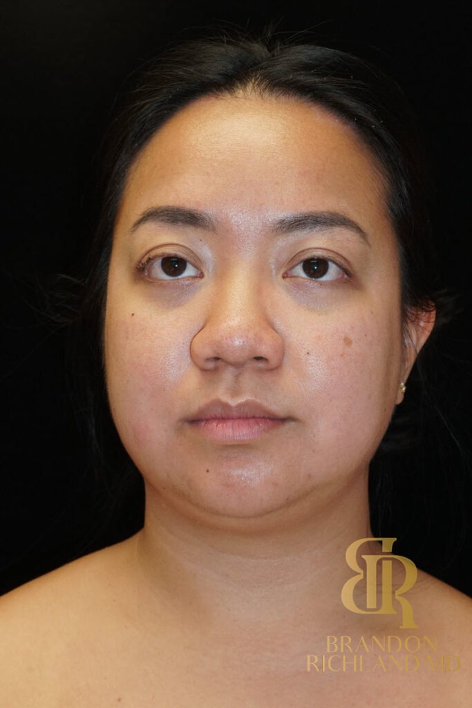 Chin Liposuction Before, Patient 08, view 1 — Dr. Brandon Richland, Newport Beach