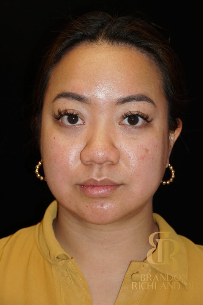 Chin Liposuction After, Patient 08, view 1 — Dr. Brandon Richland, Newport Beach