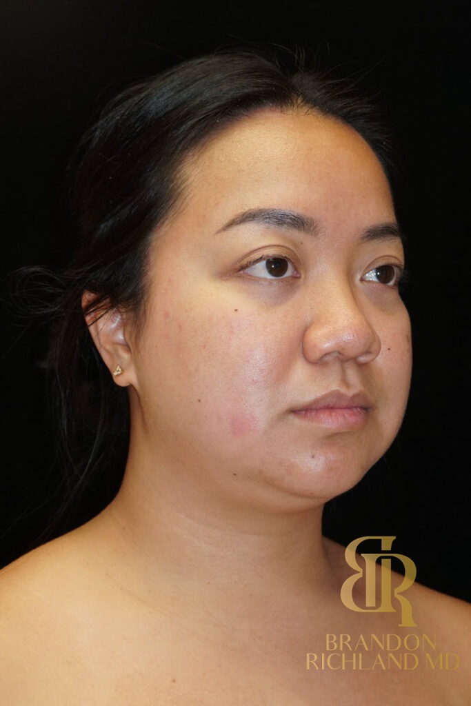 Chin Liposuction Before, Patient 08, view 2 — Dr. Brandon Richland, Newport Beach