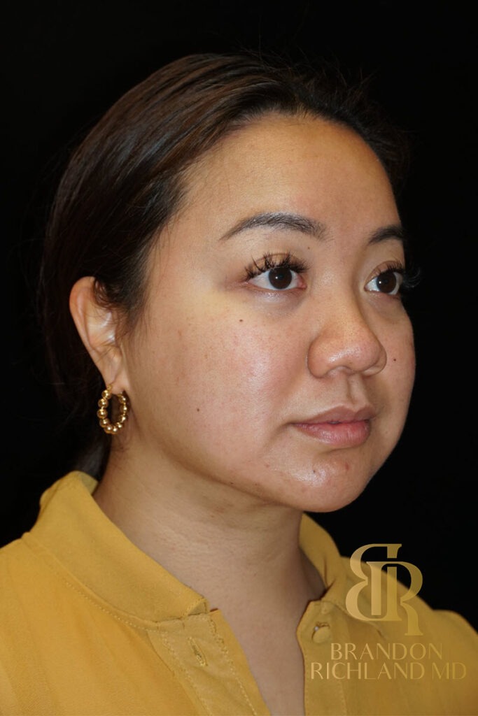 Chin Liposuction After, Patient 08, view 2 — Dr. Brandon Richland, Newport Beach