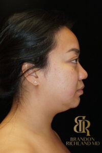 Chin Liposuction before and after, Patient 08 — Dr. Brandon Richland, Newport Beach