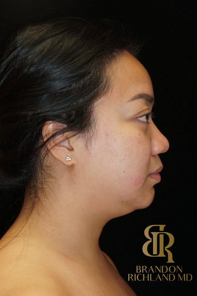 Chin Liposuction Before, Patient 08, view 3 — Dr. Brandon Richland, Newport Beach