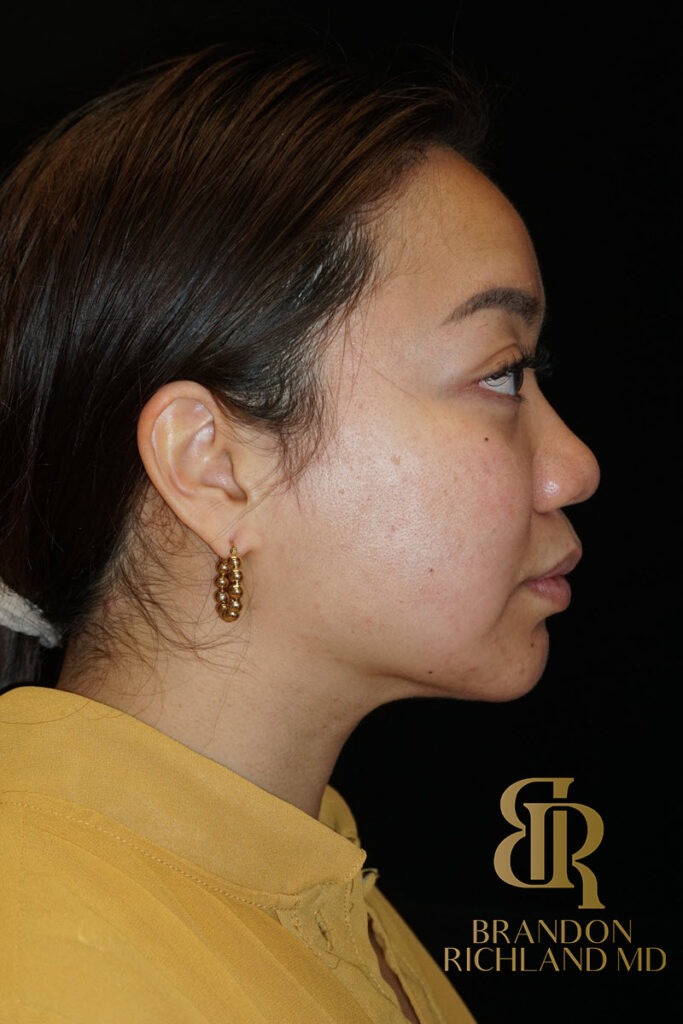 Chin Liposuction After, Patient 08, view 3 — Dr. Brandon Richland, Newport Beach