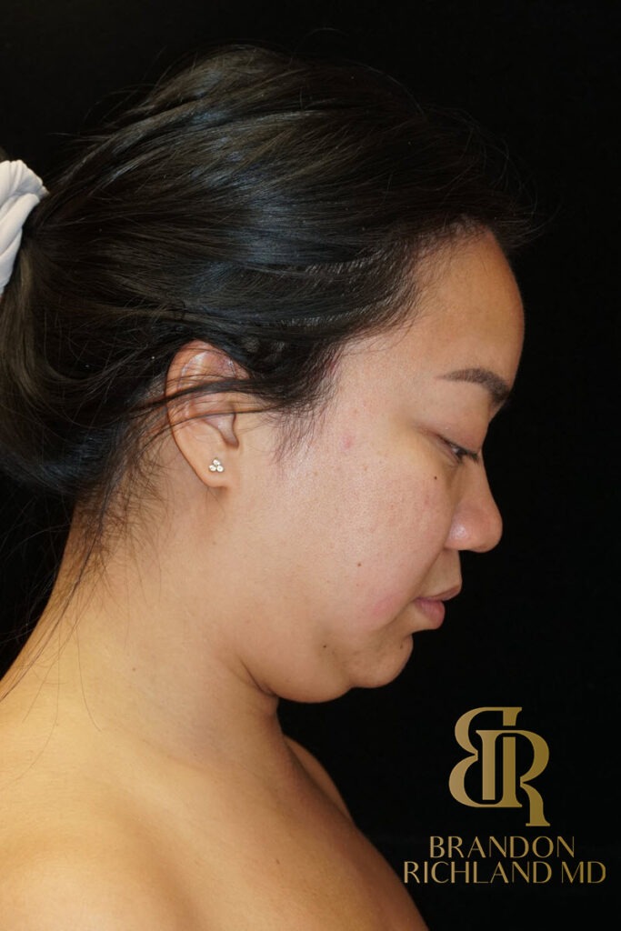 Chin Liposuction Before, Patient 08, view 4 — Dr. Brandon Richland, Newport Beach