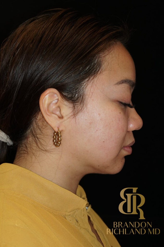 Chin Liposuction After, Patient 08, view 4 — Dr. Brandon Richland, Newport Beach