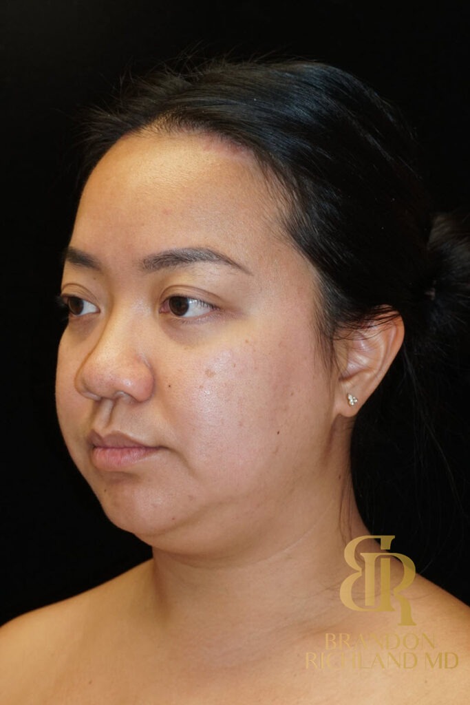 Chin Liposuction Before, Patient 08, view 5 — Dr. Brandon Richland, Newport Beach