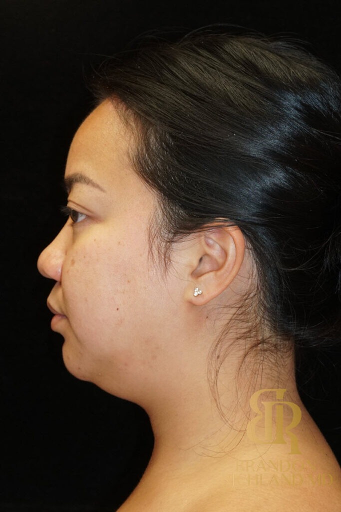 Chin Liposuction Before, Patient 08, view 6 — Dr. Brandon Richland, Newport Beach