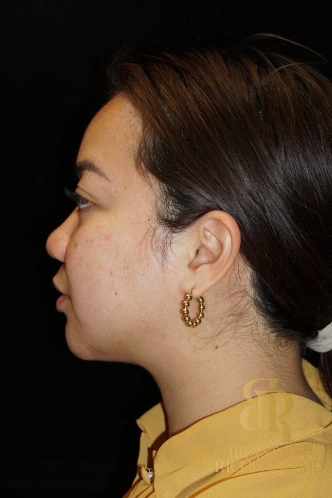 Chin Liposuction After, Patient 08, view 6 — Dr. Brandon Richland, Newport Beach