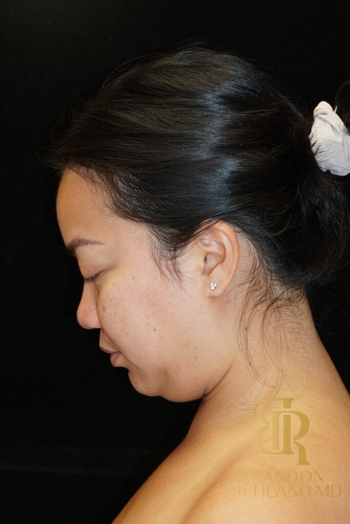 Chin Liposuction Before, Patient 08, view 7 — Dr. Brandon Richland, Newport Beach