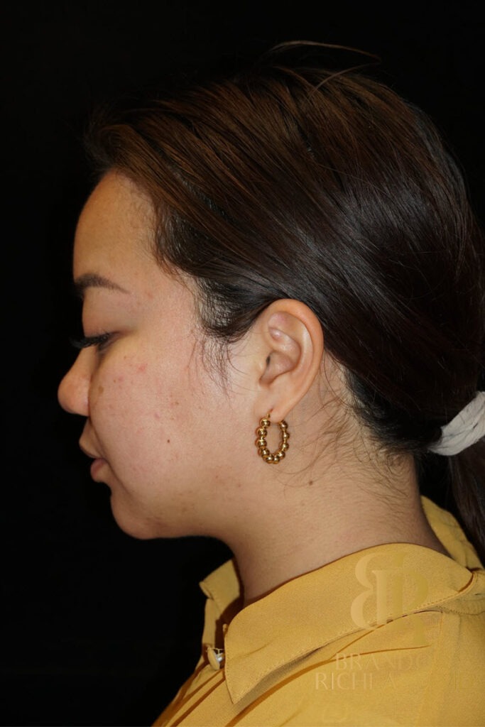 Chin Liposuction After, Patient 08, view 7 — Dr. Brandon Richland, Newport Beach