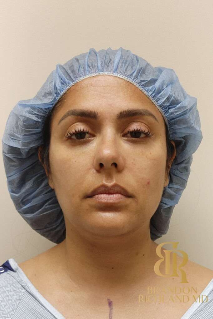 Chin Liposuction Before, Patient 09, view 1 — Dr. Brandon Richland, Newport Beach