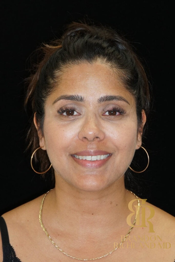 Chin Liposuction After, Patient 09, view 1 — Dr. Brandon Richland, Newport Beach