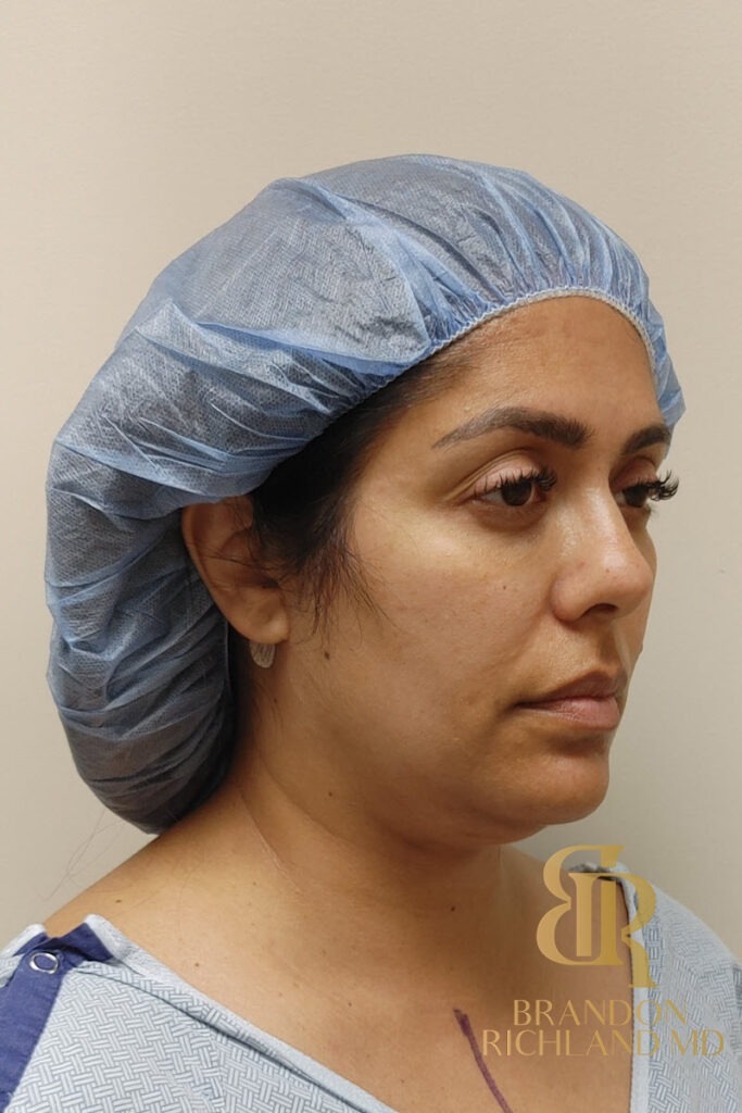 Chin Liposuction Before, Patient 09, view 2 — Dr. Brandon Richland, Newport Beach
