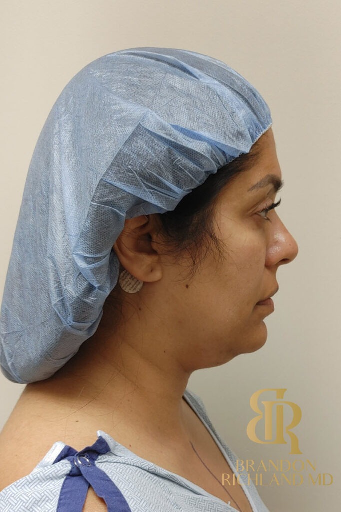 Chin Liposuction Before, Patient 09, view 3 — Dr. Brandon Richland, Newport Beach