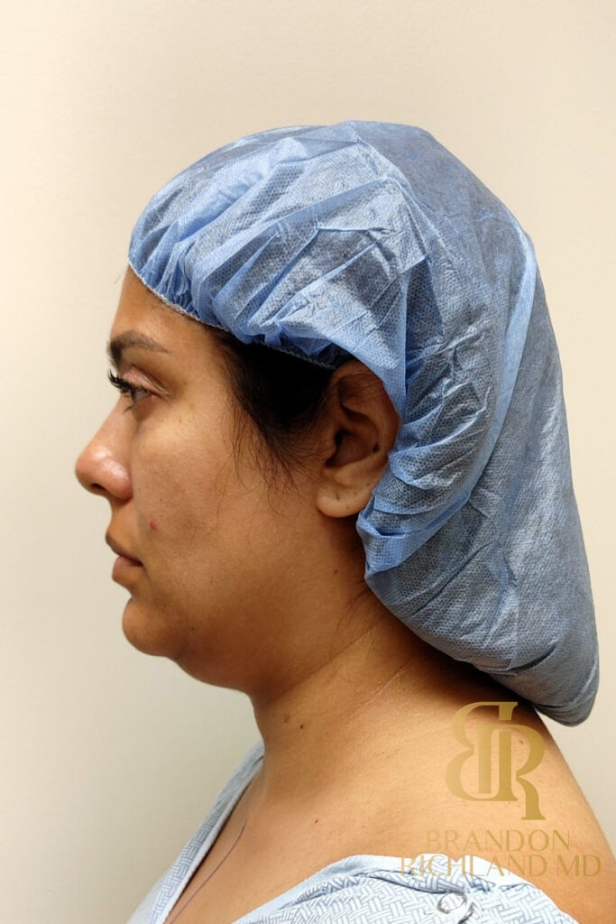 Chin Liposuction Before, Patient 09, view 6 — Dr. Brandon Richland, Newport Beach