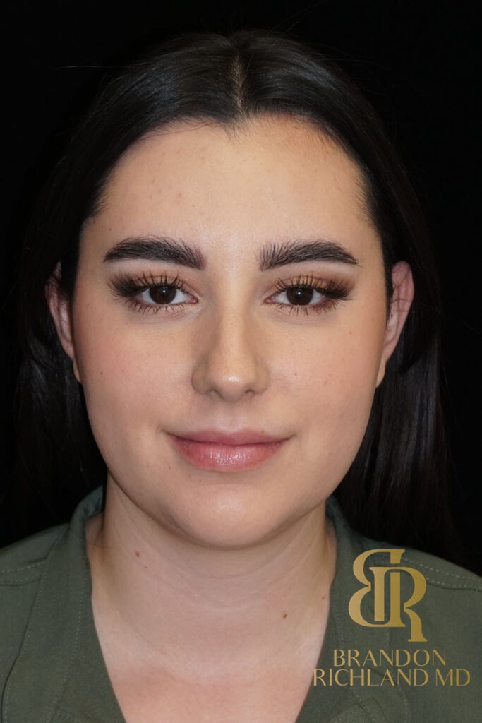 Chin Liposuction Before, Patient 10, view 1 — Dr. Brandon Richland, Newport Beach