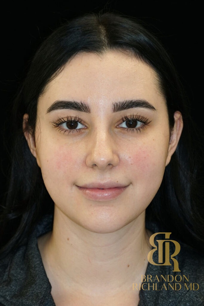 Chin Liposuction After, Patient 10, view 1 — Dr. Brandon Richland, Newport Beach