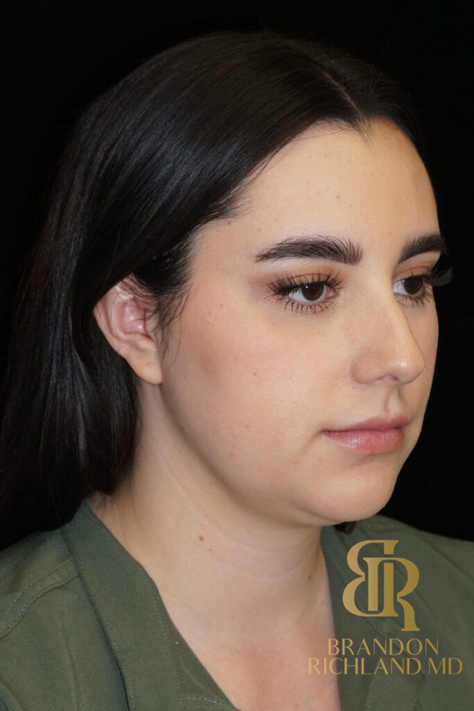 Chin Liposuction Before, Patient 10, view 2 — Dr. Brandon Richland, Newport Beach