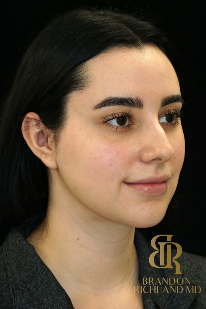 Chin Liposuction After, Patient 10, view 2 — Dr. Brandon Richland, Newport Beach